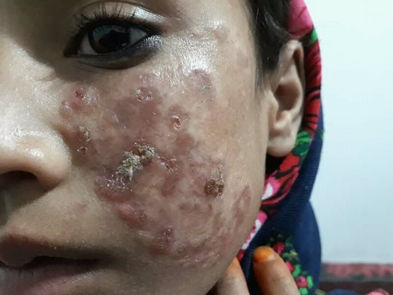 Lupus_vulgaris_new_image Lúpus: O Que É, Sintomas e Como Conviver com a Doença