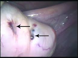 images Endometriose: Sintomas, Diagnóstico e Tratamento