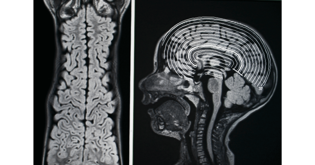 2-15-1024x538 Epilepsia: Guia Completo sobre Fisiopatologia, Tipos de Crise e Condutas Clínicas