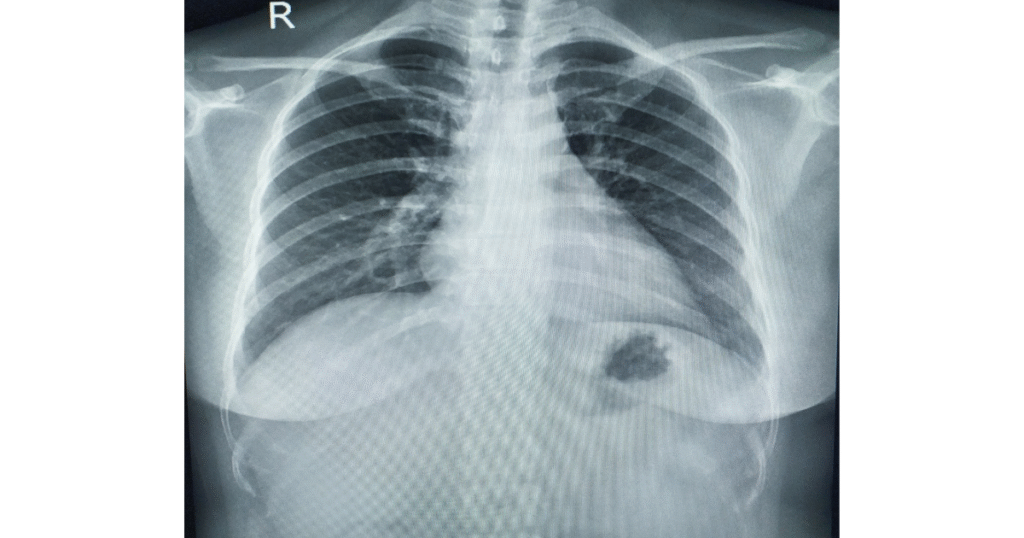 3-6-1024x538 Pneumonia: Guia Definitivo para Profissionais e Estudantes de Saúde