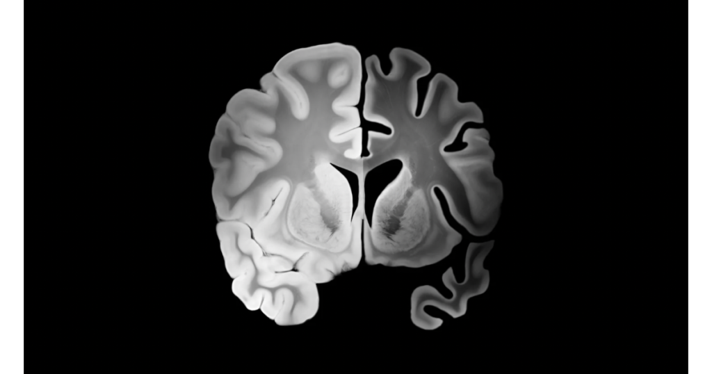 Imagens-para-blog-3-1-1024x538 Doença de Alzheimer: Estágios, Sintomas e Cuidados Essenciais para Profissionais de Saúde