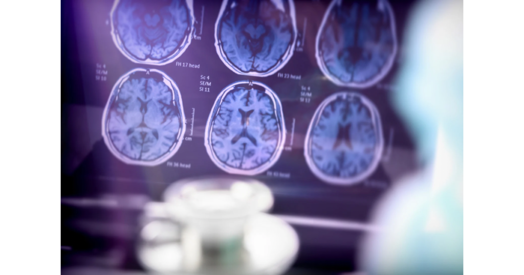 Imagens-para-blog-4-1-1024x538 Doença de Alzheimer: Estágios, Sintomas e Cuidados Essenciais para Profissionais de Saúde